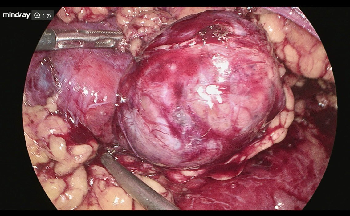 Intense and challenging surgical week at <a href="/UroHIBA/">UroHIBA</a> 
Im. 1 Laparoscopic Vesico vaginal fístula repair with omental flap 
Im.2 Intracorporeal Ileal conduit 
Im. 3 Nerve sparing RARP
Im. 4 Lap partial nephrectomy (retroperitoneal apporach)