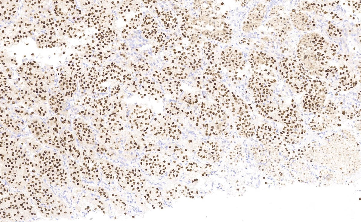 Alveolar soft part sarcoma (ASPS), nested, epithelioid cells with granular/clear cytoplasm. Rich vascular network. IHC: TFE-3
#ISBSTP #BSTPATH