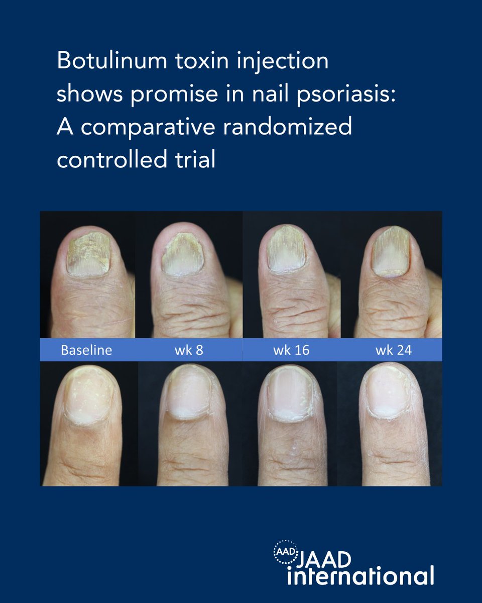Botulinum toxin A injections showed the most effective improvement in nail psoriasis, outperforming steroid injections, topical treatments, and placebo — with a 40% reduction in total target NAPSI score at 24 weeks. Read more in JAADi: bit.ly/44Oz9PF