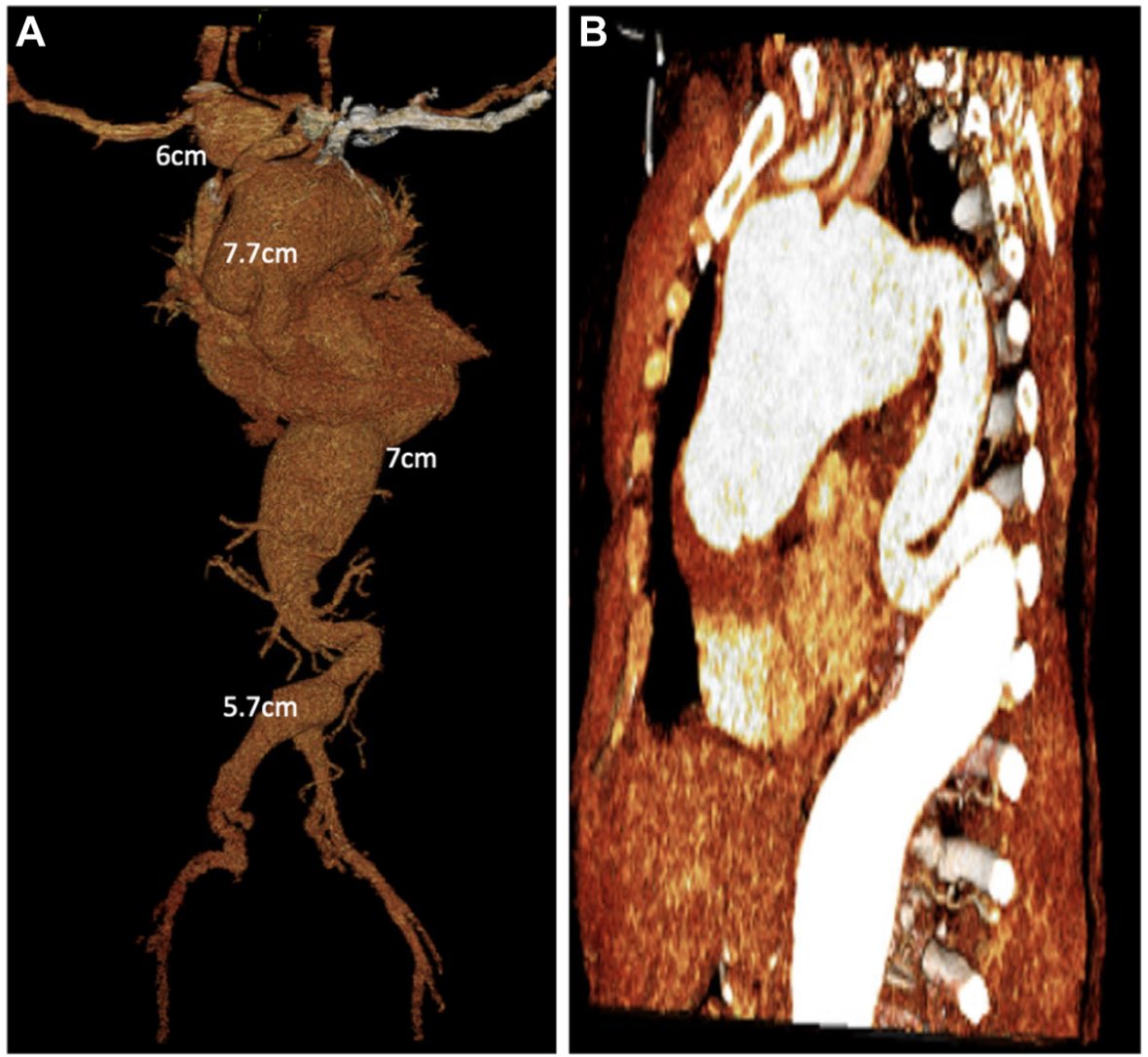 UAB Cardiothoracic Surgery (@uabctsresidency) on Twitter photo New pub alert 💥: Open 3-stage repair of multifocal aortic aneurysms in a 34-year-old by <a href="/RootGal210/">Sasha Still MD</a>, presented by graduating fellow Dr. Soler at the Fellow Case Competition <a href="/IntAorticSummit/">International Aortic Summit</a> and published in <a href="/JVascSurgCIT/">JVS-Cases Innovations and Techniques</a>
jvscit.org/article/S2468-…
#whyUABCT <a href="/UABCVI/">UAB Cardiovascular Institute</a> #AortaEd New pub alert 💥: Open 3-stage repair of multifocal aortic aneurysms in a 34-year-old by <a href="/RootGal210/">Sasha Still MD</a>, presented by graduating fellow Dr. Soler at the Fellow Case Competition <a href="/IntAorticSummit/">International Aortic Summit</a> and published in <a href="/JVascSurgCIT/">JVS-Cases Innovations and Techniques</a>
jvscit.org/article/S2468-…
#whyUABCT <a href="/UABCVI/">UAB Cardiovascular Institute</a> #AortaEd