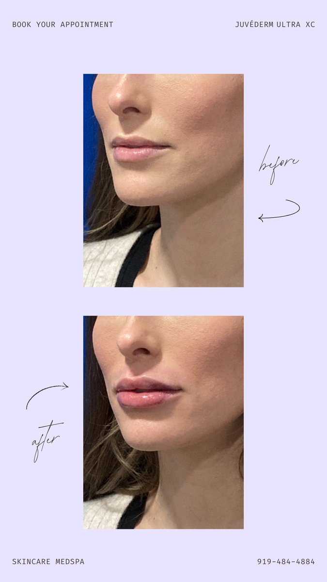 Lip filler can do more than just add volume, it helps balance your features, too. 💋 Whether you’re after a subtle, hydrated look or more shape and projection, our expert FNP-C will guide you through the perfect Juvéderm® option to fit your goals. 
#lipfiller #medspa #cary #CARE