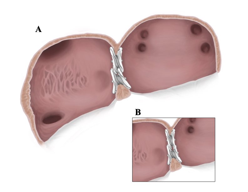 Bryan Traynor (@bryantraynor6) on Twitter photo Multiple ASDs can require multiple closure devices. We demonstrate the “interleaving” and “sandwiching” methods using the Gore Cardioform ASD Occluder and their advantages in these different anatomies. #JACCINT <a href="/JACCJournals/">JACC Journals</a> <a href="/SamiAlnasserMD/">Sami Alnasser</a> <a href="/npfam1/">Neil Fam</a> jacc.org/doi/10.1016/j.… Multiple ASDs can require multiple closure devices. We demonstrate the “interleaving” and “sandwiching” methods using the Gore Cardioform ASD Occluder and their advantages in these different anatomies. #JACCINT <a href="/JACCJournals/">JACC Journals</a> <a href="/SamiAlnasserMD/">Sami Alnasser</a> <a href="/npfam1/">Neil Fam</a> jacc.org/doi/10.1016/j.…