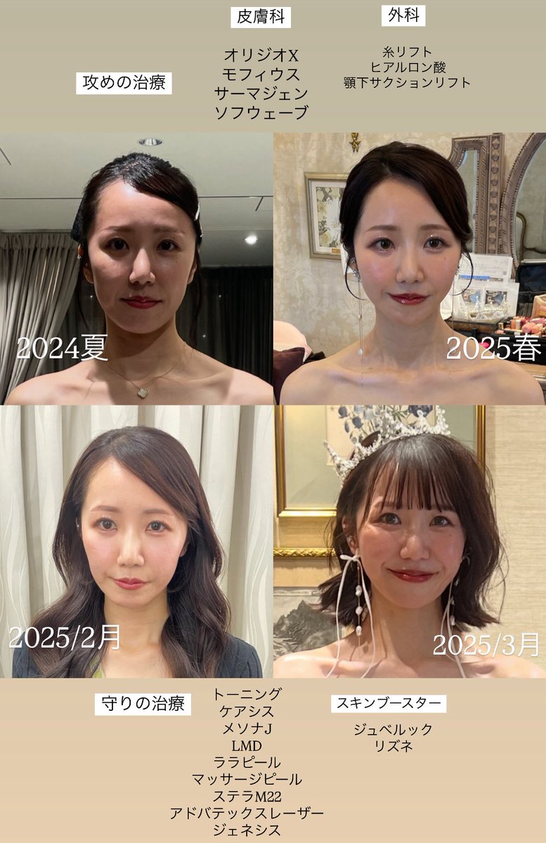 chiy12127's tweet photo. 垢抜けには「輪郭整え×メイク」が最強だと思う。花嫁美容に糸リフトは賛否両論だけど私は激推し🪡私みたいな輪郭は糸が一番盛れる！
ねちねちやっていると輪郭も定着してくるから、けして金ドブではない🪡脂肪の位置が上にくるだけで多幸感までもあると思う☺️ https://t.co/plLllg6Bg9