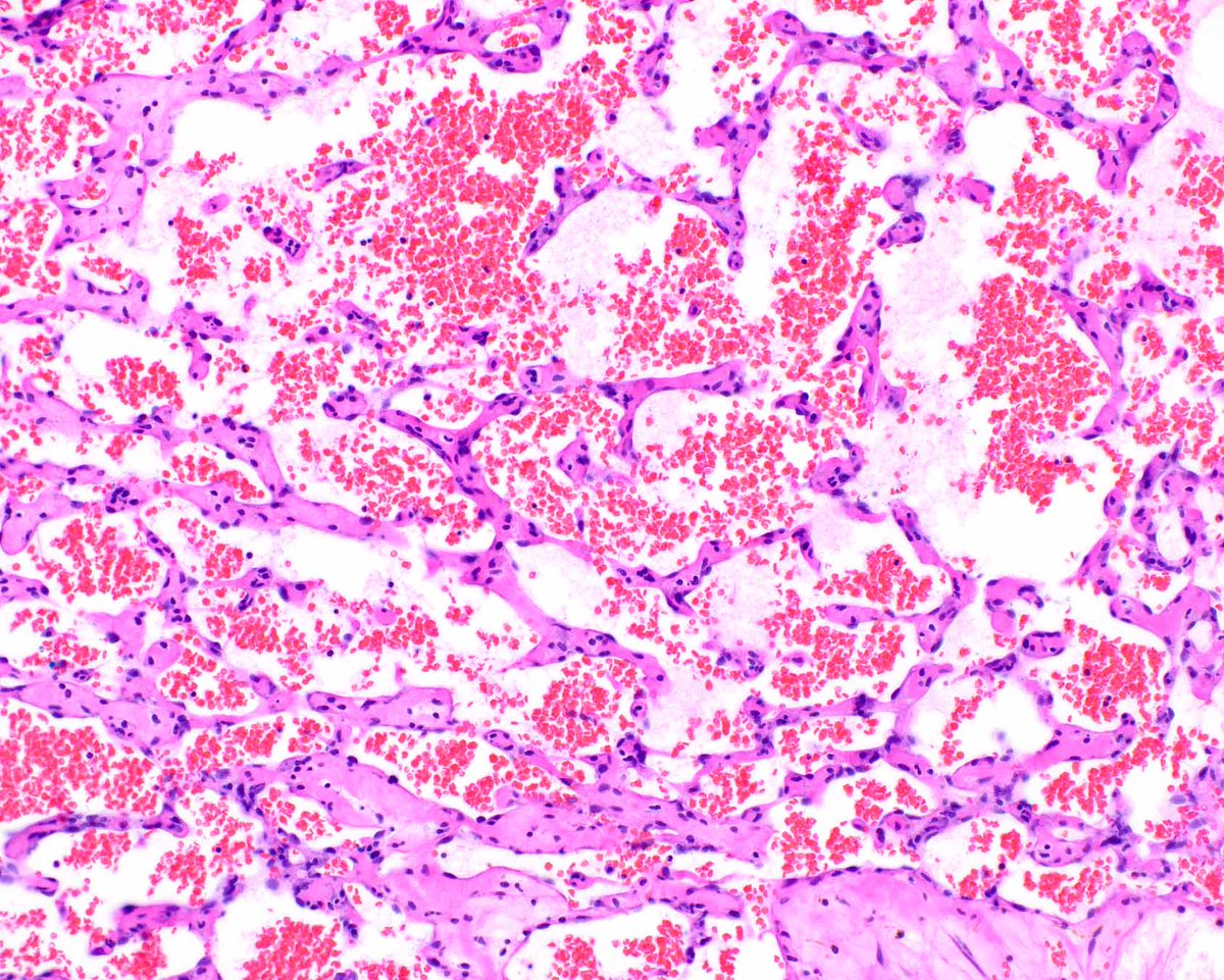 Elizabeth Montgomery, MD (@lizmontgomerymd) on Twitter photo Thrombotic hemangiomas are basically anastomosing hemangiomas that arise in the skin, but they are fun to see. <a href="/ModernPathology/">Modern Pathology</a> <a href="/science_press/">Innovative Science Press</a> #UMiamiPath
Liau JY, et al PMID: 31633489. Thrombotic hemangiomas are basically anastomosing hemangiomas that arise in the skin, but they are fun to see. <a href="/ModernPathology/">Modern Pathology</a> <a href="/science_press/">Innovative Science Press</a> #UMiamiPath
Liau JY, et al PMID: 31633489.
