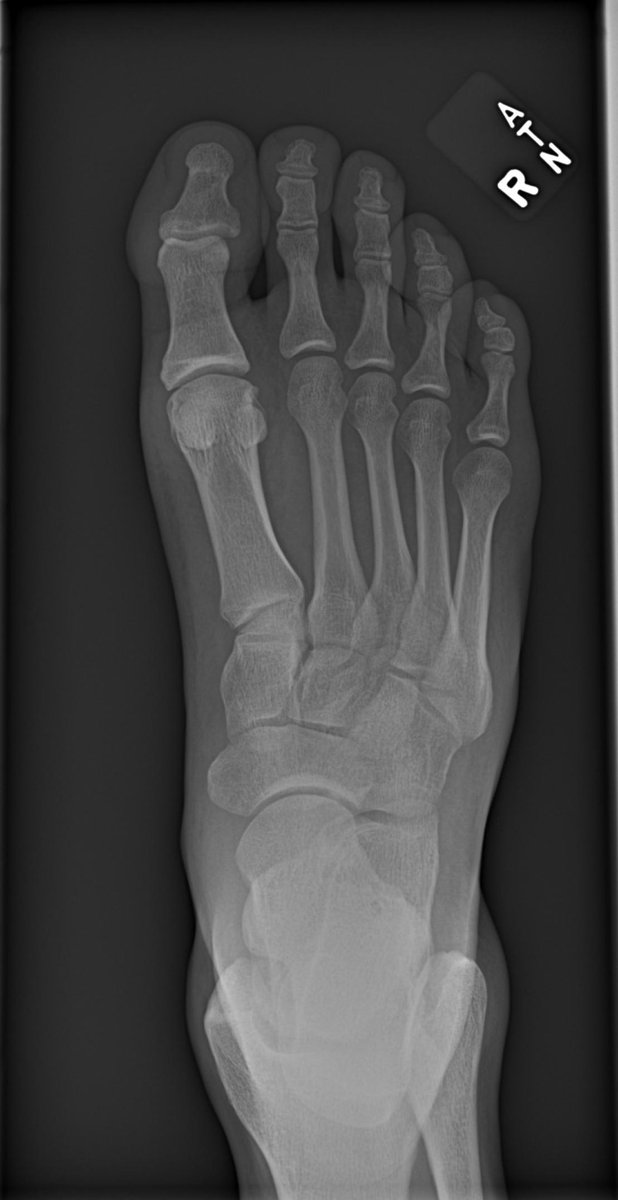 nimatheafshar's tweet photo. X ray of my foot https://t.co/aRvWK0RsFp