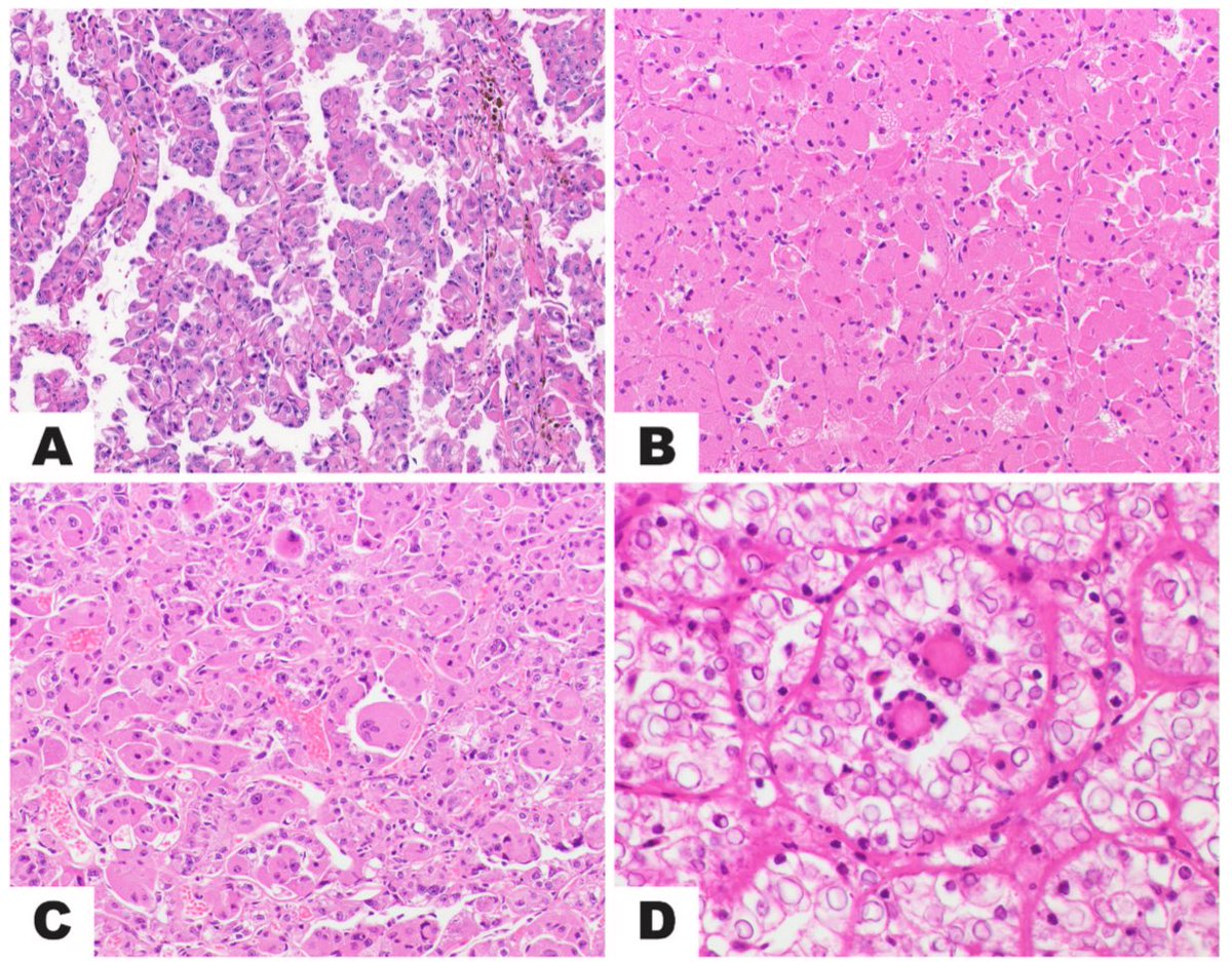 Sounak Gupta (@shounak_gupta) on Twitter photo Congratulations to <a href="/RDWhaleyMD/">Rumeal D. Whaley, MD</a> for taking on the hurculean task of reviewing 100s of translocation RCCs
Excited to see the follow up studies that are yet to come…..
Free access for the next 50 days:
kwnsfk27.r.eu-west-1.awstrack.me/L0/https:%2F%2… Congratulations to <a href="/RDWhaleyMD/">Rumeal D. Whaley, MD</a> for taking on the hurculean task of reviewing 100s of translocation RCCs
Excited to see the follow up studies that are yet to come…..
Free access for the next 50 days:
kwnsfk27.r.eu-west-1.awstrack.me/L0/https:%2F%2…