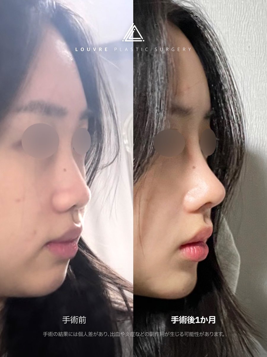 #鼻修正 1万2千件の臨床経験📷10年間医療事故０件​のDr.ユンに人生最後の #鼻整形 を受けてください📷 📷 #ルーヴル美容外科 #鼻再手術 #韓国整形 #韓国美容外科 #可愛くなりたい #韓国旅行 #ソウル #渡韓 #垢抜け #plasticsurgeon #整形 #渡韓整形 #韓国美容 #美活 #美魔女