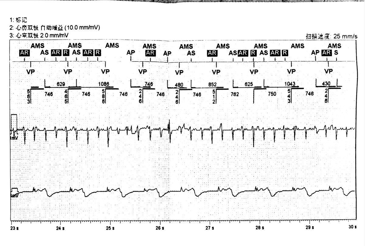 Our department has finally started doing pacemaker programming ourselves, $7 per session—purely a labor of love 😮‍💨. This also fills a gap in my personal skill set.