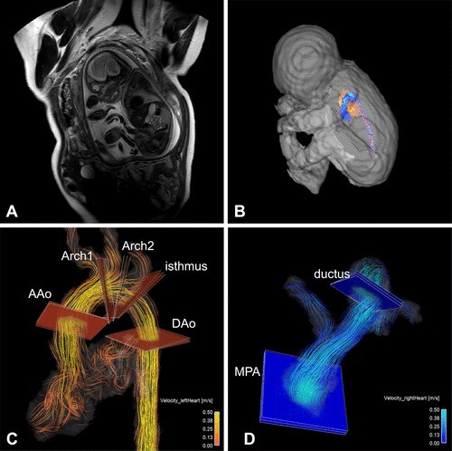 Praveen Ranganath, MD (@praveenrangana9) on Twitter photo Y’all:
Doppler-US gating 🔊
Fetal cardiac MRI 🫀🚼
4D flow 🩸
🤯
Such a fun multidisciplinary convo on this <a href="/RadiologyCTI/">Radiology: Cardiothoracic Imaging</a> episode from colleagues out of Colorado - listeners, check this one out!
Podcast 🔗 open.spotify.com/episode/3K8l26…
Paper 🔗 pubs.rsna.org/doi/10.1148/ry… Y’all:
Doppler-US gating 🔊
Fetal cardiac MRI 🫀🚼
4D flow 🩸
🤯
Such a fun multidisciplinary convo on this <a href="/RadiologyCTI/">Radiology: Cardiothoracic Imaging</a> episode from colleagues out of Colorado - listeners, check this one out!
Podcast 🔗 open.spotify.com/episode/3K8l26…
Paper 🔗 pubs.rsna.org/doi/10.1148/ry…