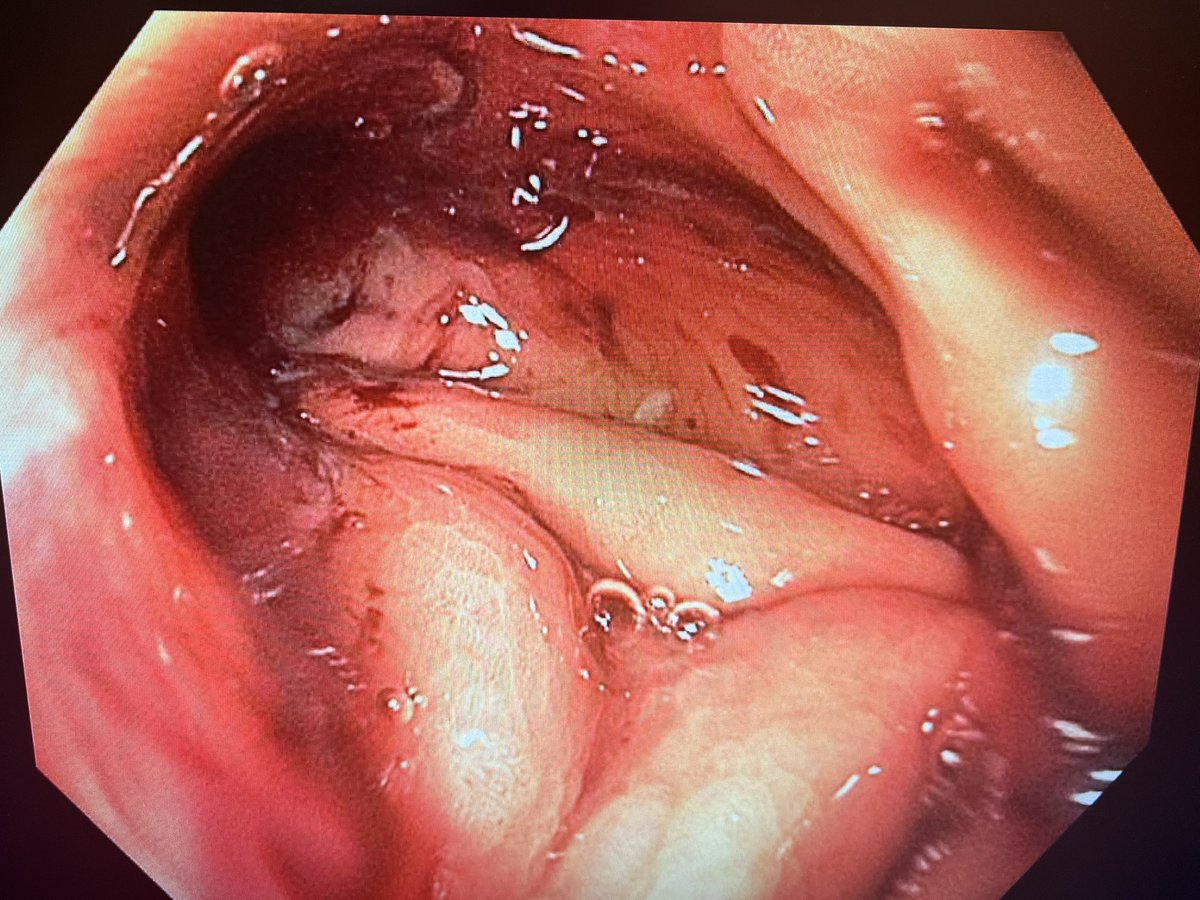 Did our first ESG (Endoscopic Sleeve Gastroplasty) here at Orlando Health Bayfront Hospital. Simple minimally invasive treatment for overweight people like me. Thanks to the collaboration with Bariatric team, excellent clinic &amp; endo staff &amp; supportive administration.