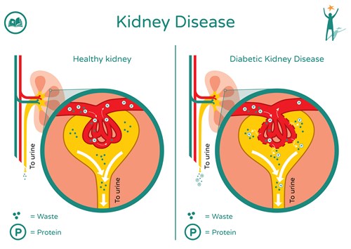TSohajda's tweet photo. today's cyclodextrin:
ZyVersa Therapeutics' Cholesterol Efflux Mediator VAR 200 (HPBCD) will be dosed in patients with diabetic kidney disease by the end of June of 2025. 

I cannot wait to see how this goes! https://t.co/ZeOzAaJ92x