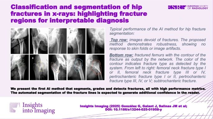 Germán González et al aimed to develop an #AI system capable of classifying and segmenting femoral fractures, and compare its performance against existing state-of-the-art methods. They found it offered high granularity in fracture classification and is the first to segment