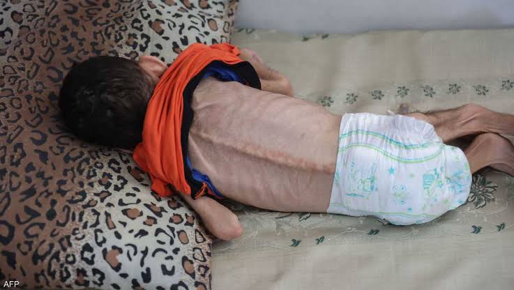 Mahmoud Ismail๐ช๐ฌ๐ต๐ธ๐ต๐ธ (@mahmoudismail85) on Twitter photo The bodies of children have become skeletons. A famine is claiming the lives of 14,000 Palestinian infants and children in the #Gaza Strip within the next 48 hours
<a href="/arableague_gs/">ุฌุงู
ุนุฉ ุงูุฏูู ุงูุนุฑุจูุฉ</a>
<a href="/UNarabic/">ุงูุฃู
ู
ุงูู
ุชุญุฏุฉ</a>
<a href="/WHOEMRO/">WHO Regional Office for the Eastern Mediterranean</a>
<a href="/WFP_Arabic/">ุจุฑูุงู
ุฌ ุงูุฃุบุฐูุฉ ุงูุนุงูู
ู ุงูุชุงุจุน ููุฃู
ู
ุงูู
ุชุญุฏุฉ</a>
<a href="/WFP_MENA/">WFP in the Middle East & North Africa</a>
#IsraelTerrorists The bodies of children have become skeletons. A famine is claiming the lives of 14,000 Palestinian infants and children in the #Gaza Strip within the next 48 hours
<a href="/arableague_gs/">ุฌุงู
ุนุฉ ุงูุฏูู ุงูุนุฑุจูุฉ</a>
<a href="/UNarabic/">ุงูุฃู
ู
ุงูู
ุชุญุฏุฉ</a>
<a href="/WHOEMRO/">WHO Regional Office for the Eastern Mediterranean</a>
<a href="/WFP_Arabic/">ุจุฑูุงู
ุฌ ุงูุฃุบุฐูุฉ ุงูุนุงูู
ู ุงูุชุงุจุน ููุฃู
ู
ุงูู
ุชุญุฏุฉ</a>
<a href="/WFP_MENA/">WFP in the Middle East & North Africa</a>
#IsraelTerrorists