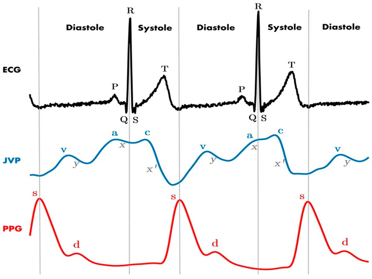 Healthcare MDPI (@healthcaremdpi_) on Twitter photo 👏New published paper by Kai Woodfall and André van Zundert <a href="/UQMedicine/">UQ Medicine</a>
Central Venous Access: An Update on Modern Techniques to Avoid Complications
💎mdpi.com/3315678 #mdpihealthcare via <a href="/HealthcareMDPI_/">Healthcare MDPI</a> 👏New published paper by Kai Woodfall and André van Zundert <a href="/UQMedicine/">UQ Medicine</a>
Central Venous Access: An Update on Modern Techniques to Avoid Complications
💎mdpi.com/3315678 #mdpihealthcare via <a href="/HealthcareMDPI_/">Healthcare MDPI</a>