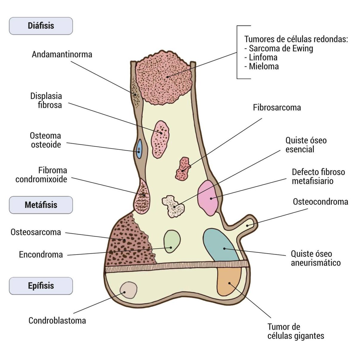 🦴 Tumores óseos primarios: localización típica según el segmento del hueso largo

Este esquema visual pertenece al contenido del Manual PROMIR de Traumatología. Consigue el tuyo o la colección completa a un precio especial si eres alumno PROMIR.

#Traumatología #TraumatologíaMIR
