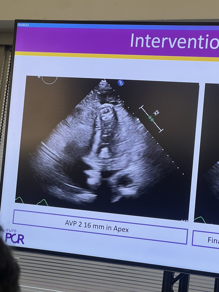 Rich_cathRT(CI)☢️ (@tesslagra) on Twitter photo Great case presentation by <a href="/fjsawaya/">Fadi Sawaya</a> 
AVP closure of a ruptured apex Great case presentation by <a href="/fjsawaya/">Fadi Sawaya</a> 
AVP closure of a ruptured apex