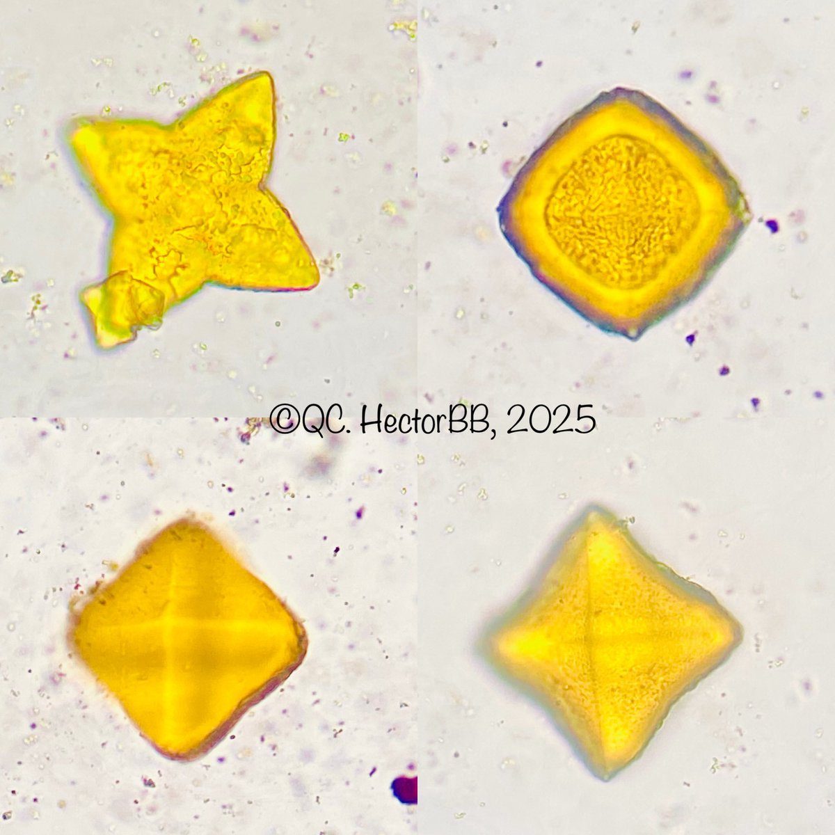 HectorBB24's tweet photo. Calcium oxalate crystals stained by bilirubin https://t.co/xzvjenbUpa