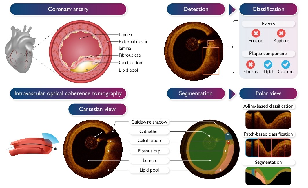European Society of Cardiology Journals (@esc_journals) on Twitter photo Review and recommendations for using #ArtificialIntelligence in intracoronary optical coherence tomography analysis ow.ly/1Imy50VXyYf
#EHJDigital #OCT <a href="/BruiningNico/">Nico Bruining EiC EHJ Digital Health</a> <a href="/rafavidalperez/">rafavidalperez</a> <a href="/fwasselbergs/">Folkert Asselbergs</a> <a href="/EAPCIPresident/">EAPCIPresident</a> Review and recommendations for using #ArtificialIntelligence in intracoronary optical coherence tomography analysis ow.ly/1Imy50VXyYf
#EHJDigital #OCT <a href="/BruiningNico/">Nico Bruining EiC EHJ Digital Health</a> <a href="/rafavidalperez/">rafavidalperez</a> <a href="/fwasselbergs/">Folkert Asselbergs</a> <a href="/EAPCIPresident/">EAPCIPresident</a>