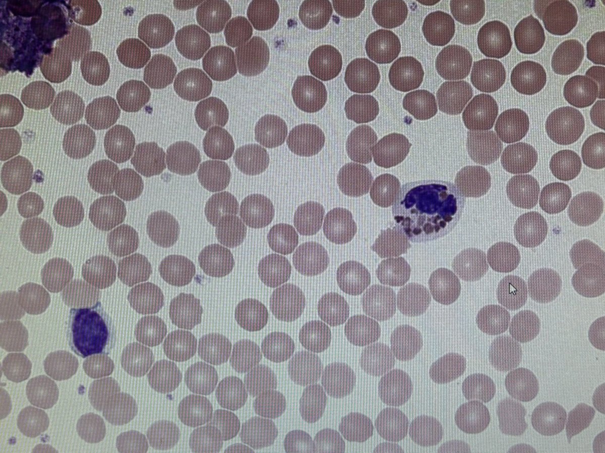 6 year old male. Normal counts. 

Film 👇

Thoughts?
