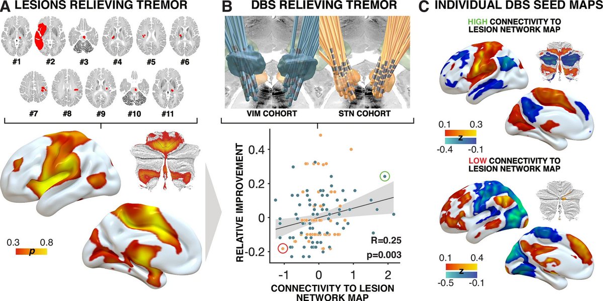 The Science of Parkinson's (@scienceofpd) on Twitter photo New research from <a href="/LLGoede/">Lukas Goede</a> <a href="/andreashorn_/">Andreas Horn</a> & colleagues provides a robust, cross-condition tremor network that may guide both invasive & noninvasive neuromodulation strategies for #Parkinsons & essential tremor
nature.com/articles/s4146… New research from <a href="/LLGoede/">Lukas Goede</a> <a href="/andreashorn_/">Andreas Horn</a> & colleagues provides a robust, cross-condition tremor network that may guide both invasive & noninvasive neuromodulation strategies for #Parkinsons & essential tremor
nature.com/articles/s4146…