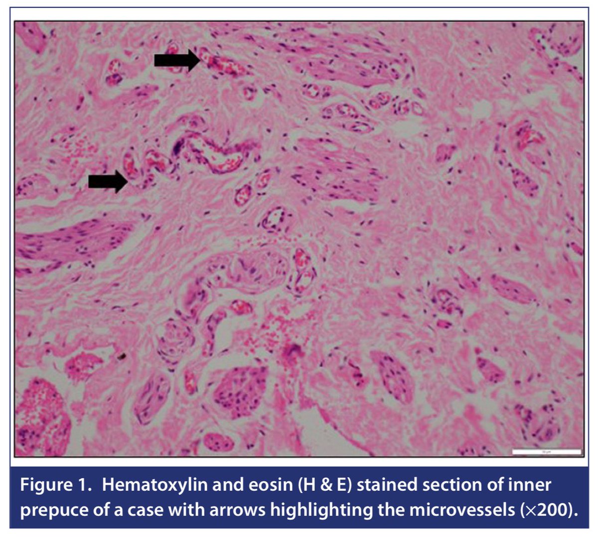 TurkJUrol's tweet photo. Comparison of Microvessel Density and Growth Factor Levels Between Inner and Outer Prepuce in Distal Hypospadias
Gaurav Prasad et al.
#growthfactor #hypospadias #microvesseldensity
Article Link:
https://t.co/TGPfGUAuN5 https://t.co/OtjfinL6R5