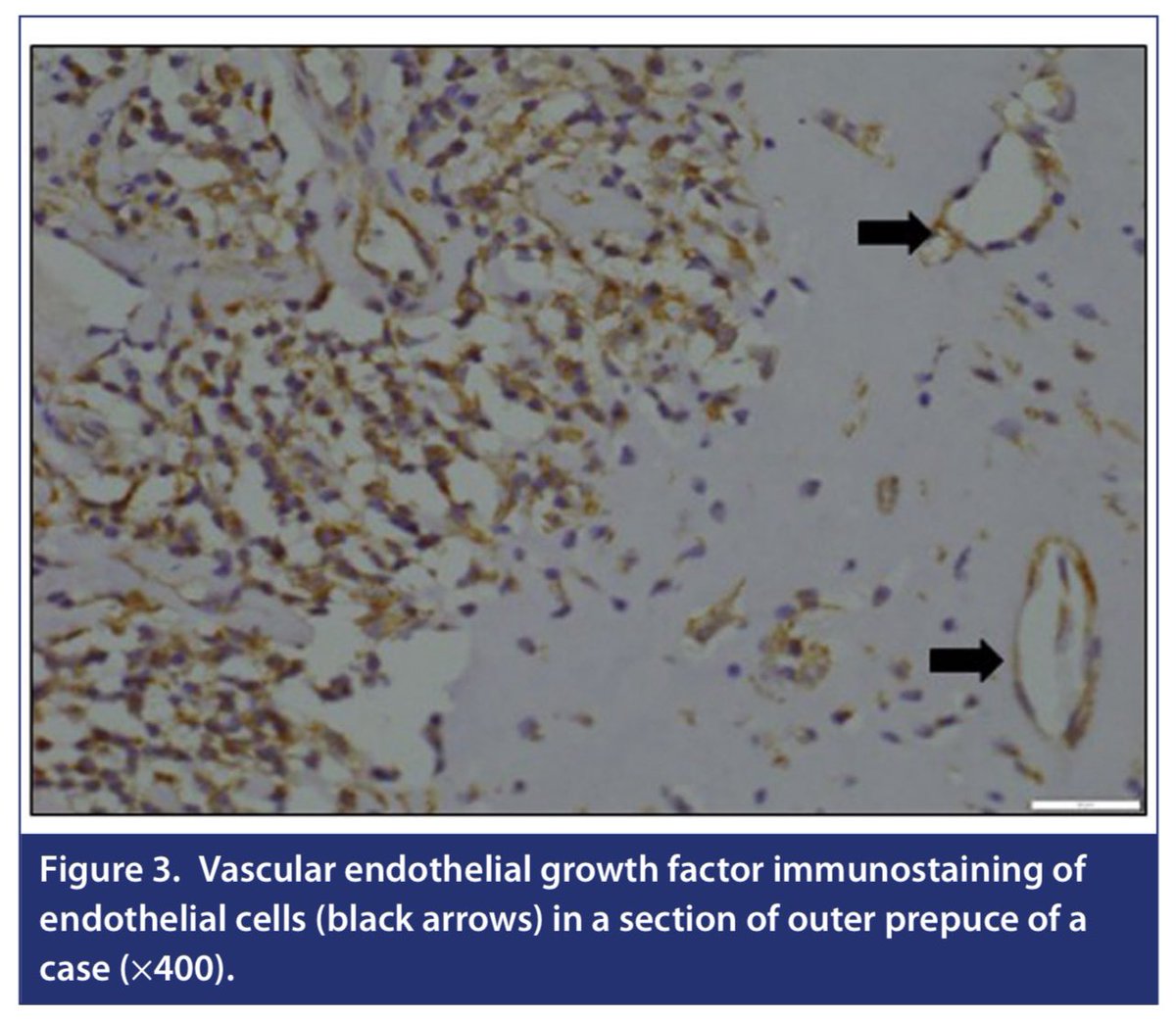 TurkJUrol's tweet photo. Comparison of Microvessel Density and Growth Factor Levels Between Inner and Outer Prepuce in Distal Hypospadias
Gaurav Prasad et al.
#growthfactor #hypospadias #microvesseldensity
Article Link:
https://t.co/TGPfGUAuN5 https://t.co/OtjfinL6R5