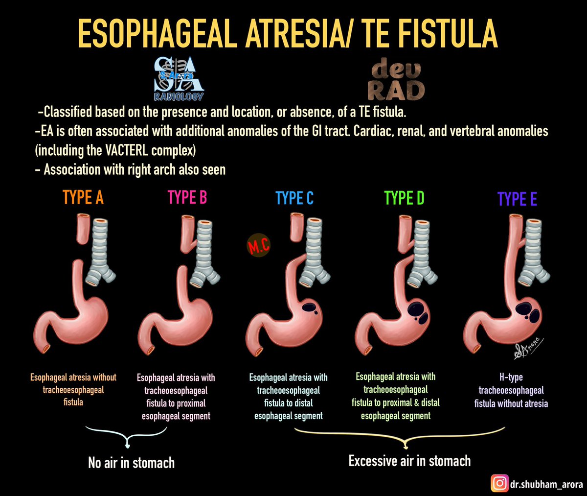 Dr_S_Arora's tweet image. Slide on Esophaegal atresia and Tracheoesophageal fistula.
@drdevrad
#radiology #Medx