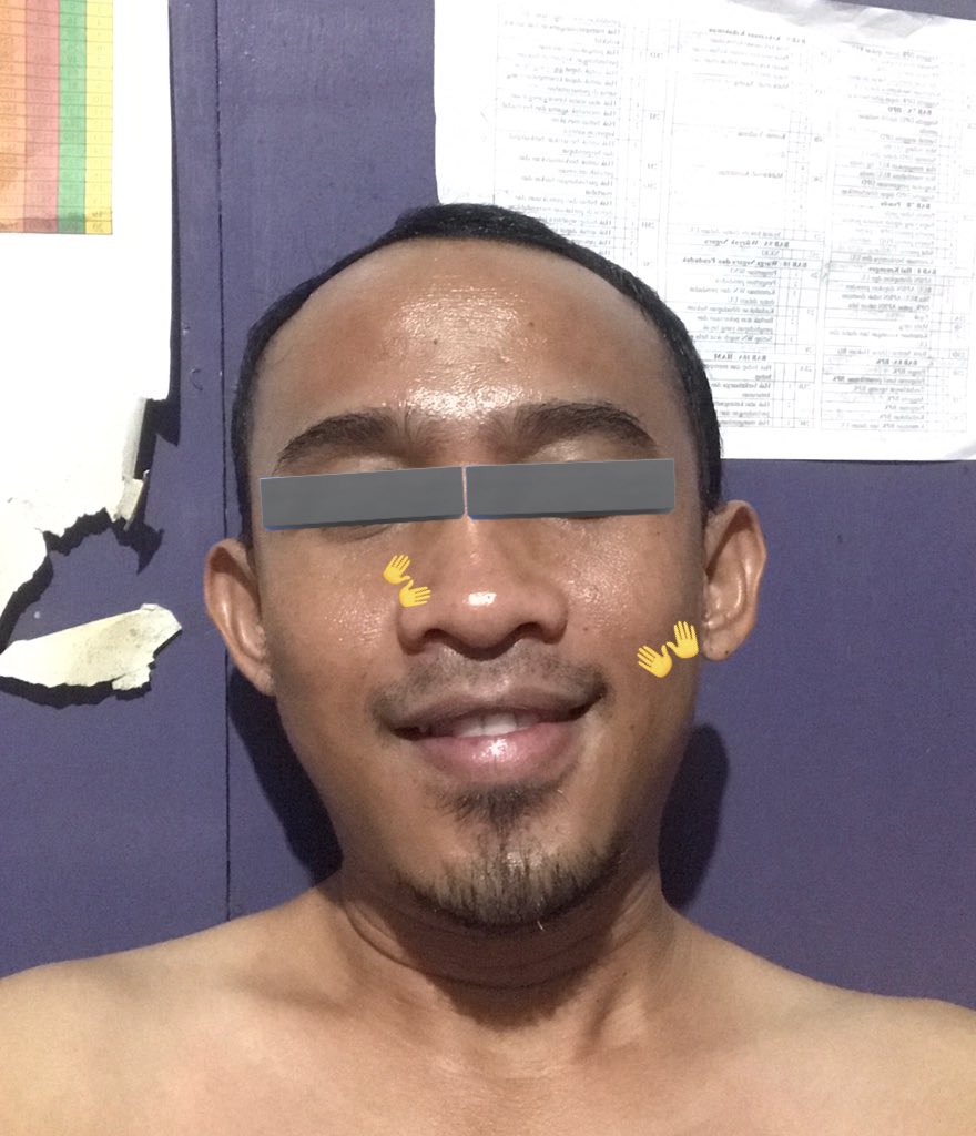 TLD_Survive's tweet photo. So happy my darkspot bekas jerawat yang ditandai dengan ikon tangan sudah sangat amat memudar dengan pemakaian teratur #Hexylresorcinol #ForSkinSake @ForSkinsSake
sumpah di aku cocok lohhh . dikalian gmn? π₯°π₯°π₯° semoga cocok jg..
yang masih ada problem darkspot bisa ikhtiar y https://t.co/m8bGUlX7B0