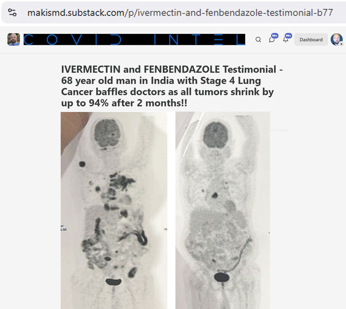 MakisMedicine's tweet photo. NEW ARTICLE: IVERMECTIN and FENBENDAZOLE Testimonial - 68 year old man in India with Stage 4 Lung Cancer baffles doctors as all tumors shrink by up to 94% after 2 months!!

This success story from India is dedicated to everyone who attacked me this week 😃

If you think I'm only helping cancer patients in North America, you'd be wrong...

68 year old man in India was diagnosed with Stage 4 Lung Cancer with metastases in the lymph nodes, bones, liver, spleen and brain

His family reached out to my Ivermectin Cancer Clinic.

We started:
Ivermectin 1mg/kg/day
Fenbendazole 1000mg/day

Results after 2 months:

"His doctor did not say any word after seeing the report. He just mentioned report is OK, we will complete the remaining chemo cycle. Inside I knew he was also shocked to see the report.

"I can not thank you enough"

PET/CT showed shrinkage and decreased metabolism of EVERY metastatic tumor including in the brain.

Example:

Right Lung Primary Malignancy:
3.2x2.7x3.5cm shrunk to 1.6x1.0x1.2cm 
(94% tumor volume shrinkage)
SUV 14.5 to SUV 3.1

"Hypermetabolic mediastinal lymph nodes, spleen lesion and brain lesion and liver lesion with low significant metabolism. Interval significant reduction in metabolic activity and size"

I am helping Cancer patients shock their Oncologists around the globe! 😃

Even in India! 🙏

I would like to thank everyone for the recent coordinated attacks on Ivermectin and Fenbendazole and my efforts to help Stage 4 Cancer patients.

1. You've made me #1 rising Sub.Stack in the world
2. I did two major interviews today
3. and my inboxes are flooded with requests for help

And that means, more cancer patients will get help...God bless you for helping! 😃

Did you see those PET images? The before and after?
No wonder the Oncologist was speechless!! 🙏

Article Link in photo to avoid shadowban, just re-type the URL in the first photo at the top, into your browser to access.

@joerogan