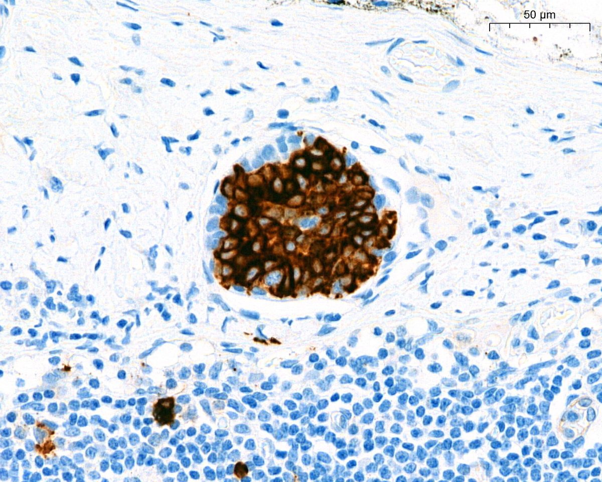 A. Polónia (@poloniaantonio) on Twitter photo Revelation day!😃Plot twist (hidden plot) This is CD117! What´s the dx? <a href="/atman_ci/">Dr. Luca</a> <a href="/DrGeeONE/">Olaleke Folaranmi</a> <a href="/fouad_boulos/">Fouad Boulos</a> <a href="/RazaHoda/">Raza Hoda MD</a> <a href="/ADamronMD/">Alexander Damron, MD</a> <a href="/Teclis82/">Brian McMillen MD</a> <a href="/LizaMQuintana/">Liza Quintana, MD</a> <a href="/tlabiano/">Tania Labiano</a> <a href="/A_Morini_MD/">Aurélien Morini, MD, MSc 🇫🇷🇪🇺💙💛</a> <a href="/ariella8/">Celina Stayerman MD</a> <a href="/surgpathlahore/">Nusrat Z. Bokhari</a> <a href="/amalasar86/">Amal Asar, FRCPath, MAcadMED</a> <a href="/TristanRutland7/">Tristan Rutland MBBS FRCPA IFCAP</a> <a href="/israhkhan/">Israh Akhtar Khan</a> <a href="/kis_lorand/">Lorand Kis</a> <a href="/padmapathology1/">Padma Priya J</a> <a href="/DrBMcGinn/">Barry McGinn</a> Revelation day!😃Plot twist (hidden plot) This is CD117! What´s the dx? <a href="/atman_ci/">Dr. Luca</a> <a href="/DrGeeONE/">Olaleke Folaranmi</a> <a href="/fouad_boulos/">Fouad Boulos</a> <a href="/RazaHoda/">Raza Hoda MD</a> <a href="/ADamronMD/">Alexander Damron, MD</a> <a href="/Teclis82/">Brian McMillen MD</a> <a href="/LizaMQuintana/">Liza Quintana, MD</a> <a href="/tlabiano/">Tania Labiano</a> <a href="/A_Morini_MD/">Aurélien Morini, MD, MSc 🇫🇷🇪🇺💙💛</a> <a href="/ariella8/">Celina Stayerman MD</a> <a href="/surgpathlahore/">Nusrat Z. Bokhari</a> <a href="/amalasar86/">Amal Asar, FRCPath, MAcadMED</a> <a href="/TristanRutland7/">Tristan Rutland MBBS FRCPA IFCAP</a> <a href="/israhkhan/">Israh Akhtar Khan</a> <a href="/kis_lorand/">Lorand Kis</a> <a href="/padmapathology1/">Padma Priya J</a> <a href="/DrBMcGinn/">Barry McGinn</a>