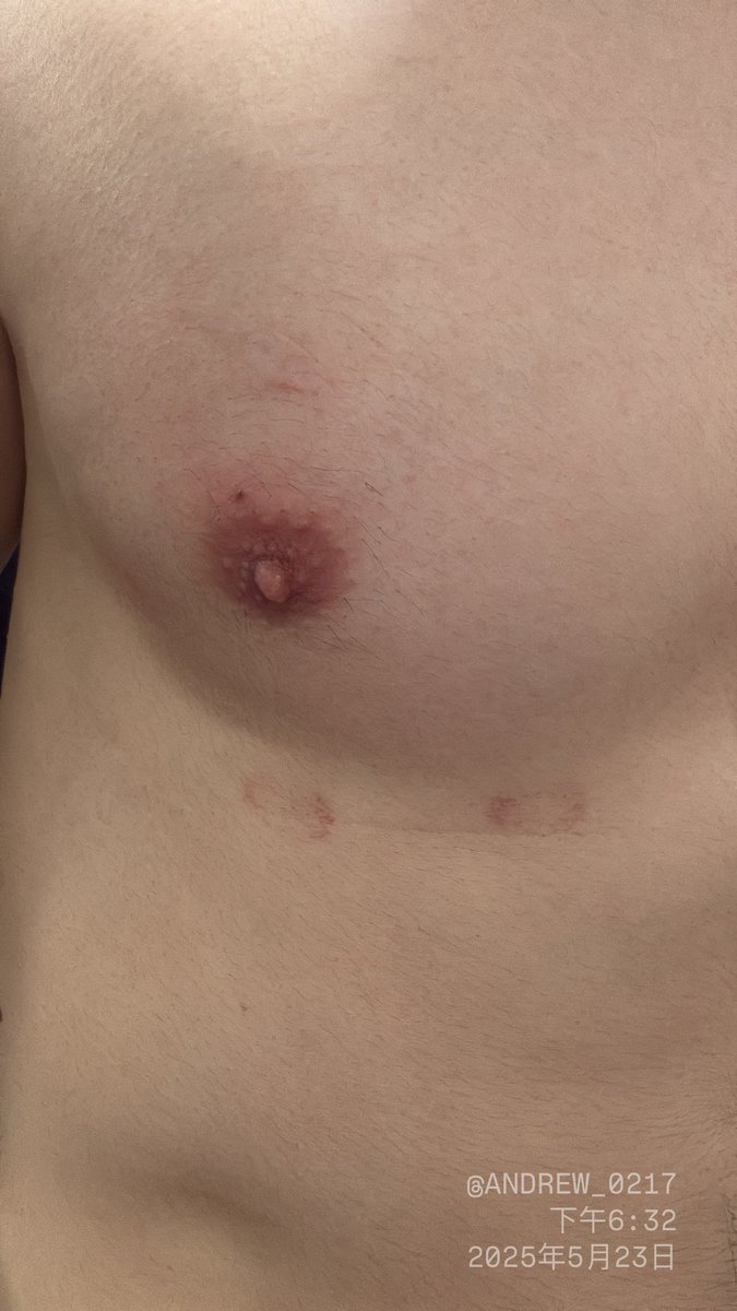 做完心電圖檢查⋯
怎麼很像被種兩個草莓🫣