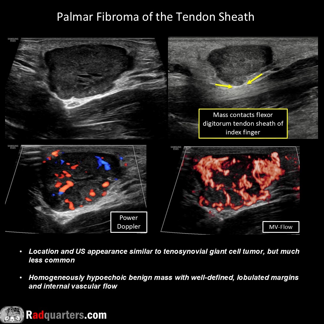 Radquarters's tweet image. 📽️ Watch video to learn more: bit.ly/rq-gct
#FOAMrad #FOAMed #mskrad #usrad #radres #radtech #medstudent #radquarters @BostonImaging @SamsungHealth