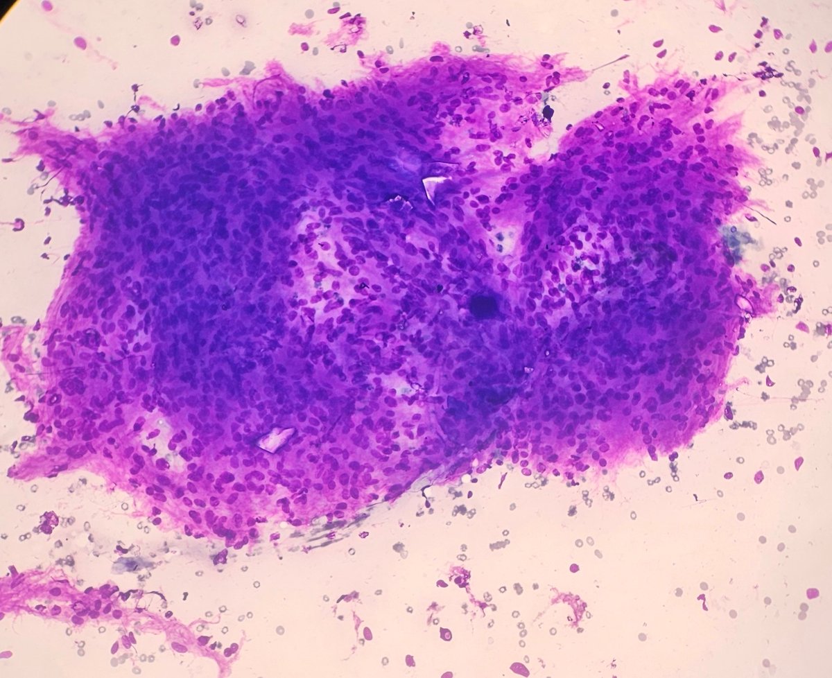 AnupamaArya12's tweet photo. 52/F FNAC-cervical lymph node.She has multiple lymph nodes. #cytopath #pathtwitter #lymphnode @pepeheffernan @vi_monappa @kriyer68 @DrGeeONE @kr_abhisek https://t.co/QivkciZci8
