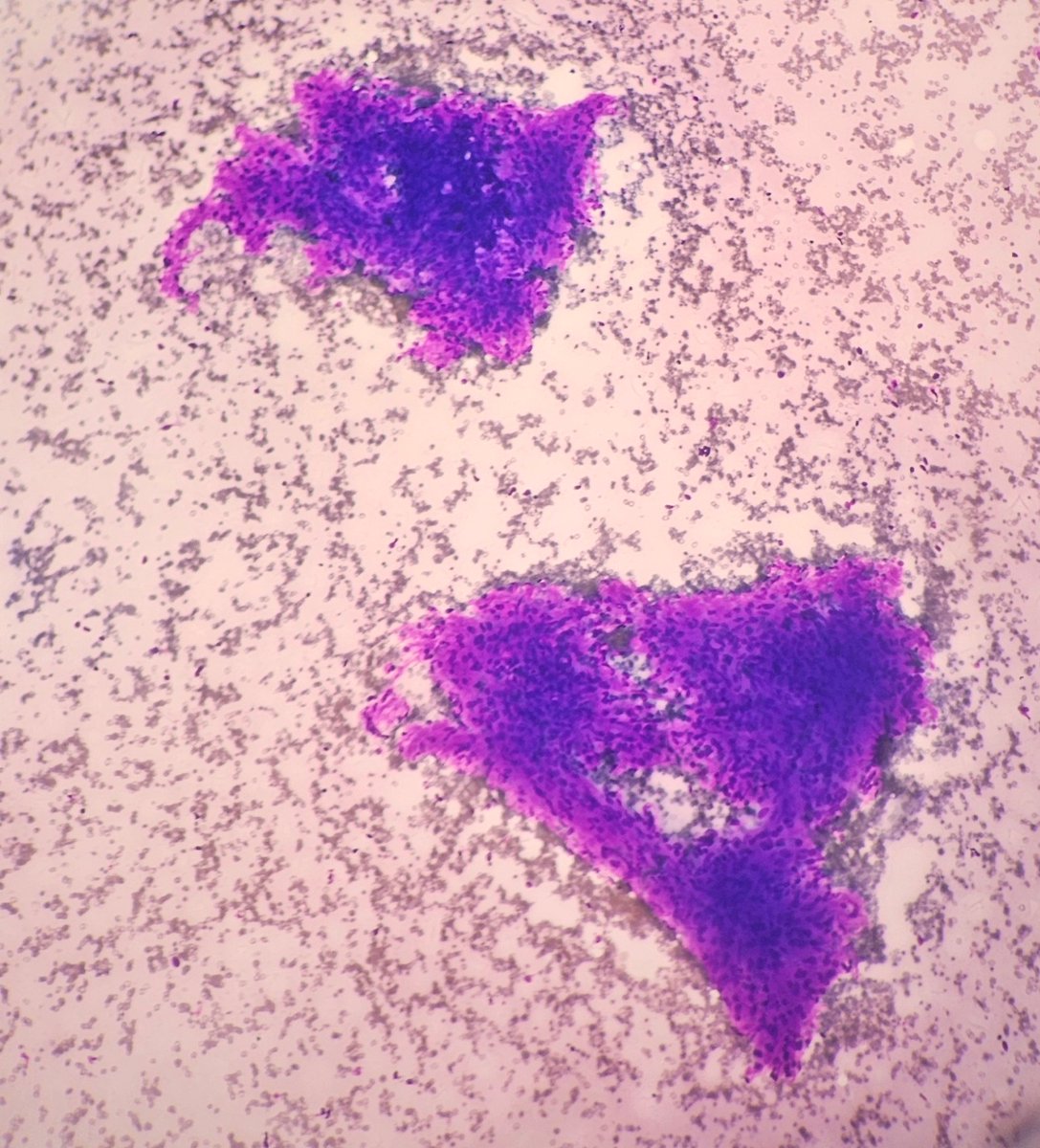 AnupamaArya12's tweet photo. 52/F FNAC-cervical lymph node.She has multiple lymph nodes. #cytopath #pathtwitter #lymphnode @pepeheffernan @vi_monappa @kriyer68 @DrGeeONE @kr_abhisek https://t.co/QivkciZci8