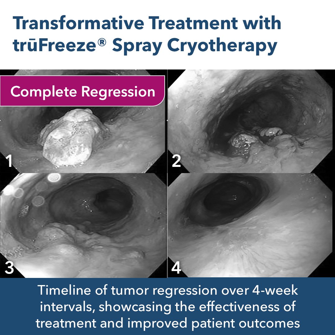 STERIS Endoscopy (@sterisendoscopy) on Twitter photo BEFORE AND AFTER trūFreeze® Spray Cryotherapy treatment for esophageal cancer. Witness the transformation as the esophageal lumen transitions from being filled with cancer to a clear path of recovery.
Reach out to trufreeze@steris.com for more information or click here to BEFORE AND AFTER trūFreeze® Spray Cryotherapy treatment for esophageal cancer. Witness the transformation as the esophageal lumen transitions from being filled with cancer to a clear path of recovery.
Reach out to trufreeze@steris.com for more information or click here to