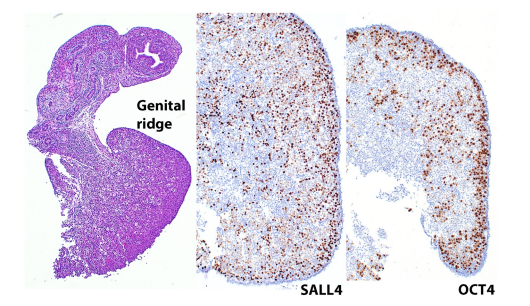 mreyesm's tweet image. Happy to share our new contribution to the #Pasthology #PediPath of #DisordersOfSexDevelopment published today in CA: A Cancer Journal for Clinicians (IF: 512) 😅We hope you find it useful! #Uropath @UMiamiPathology pubmed.ncbi.nlm.nih.gov/40406981/