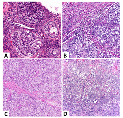 mreyesm's tweet image. Happy to share our new contribution to the #Pasthology #PediPath of #DisordersOfSexDevelopment published today in CA: A Cancer Journal for Clinicians (IF: 512) 😅We hope you find it useful! #Uropath @UMiamiPathology pubmed.ncbi.nlm.nih.gov/40406981/