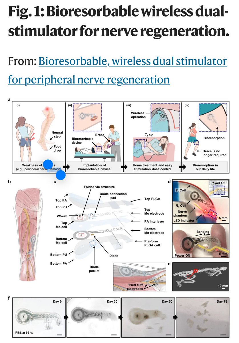 C.K. Franz, M.D., Ph.D. (@colinfranzmdphd) on Twitter photo Pleased to share our latest research <a href="/AbilityLab/">Shirley Ryan AbilityLab</a> <a href="/NorthwesternPMR/">NU Physical Medicine and Rehabilitation</a> <a href="/NMNeurology/">NM Neurology</a> in collaboration with my colleague <a href="/ProfJohnARogers/">John A Rogers</a> <a href="/NU_QSIB/">Querrey Simpson Institute for Bioelectronics</a>: Bioresorbable, wireless dual stimulator for peripheral nerve regeneration. pubmed.ncbi.nlm.nih.gov/40404648/ Pleased to share our latest research <a href="/AbilityLab/">Shirley Ryan AbilityLab</a> <a href="/NorthwesternPMR/">NU Physical Medicine and Rehabilitation</a> <a href="/NMNeurology/">NM Neurology</a> in collaboration with my colleague <a href="/ProfJohnARogers/">John A Rogers</a> <a href="/NU_QSIB/">Querrey Simpson Institute for Bioelectronics</a>: Bioresorbable, wireless dual stimulator for peripheral nerve regeneration. pubmed.ncbi.nlm.nih.gov/40404648/