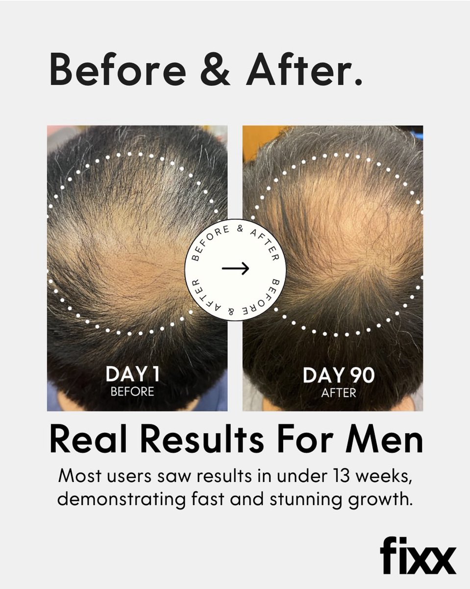 Are you ready!? We sure are! Click the link in our bio so register! #hairgrowth #live #joinus #hairloss