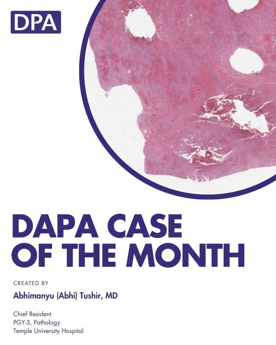 dpatweet's tweet image. A 7-year-old boy is brought to clinic with a several-month history of easy bruising, fatigue, and recurrent bone pain.
Take the assessment: zurl.co/MCmkH