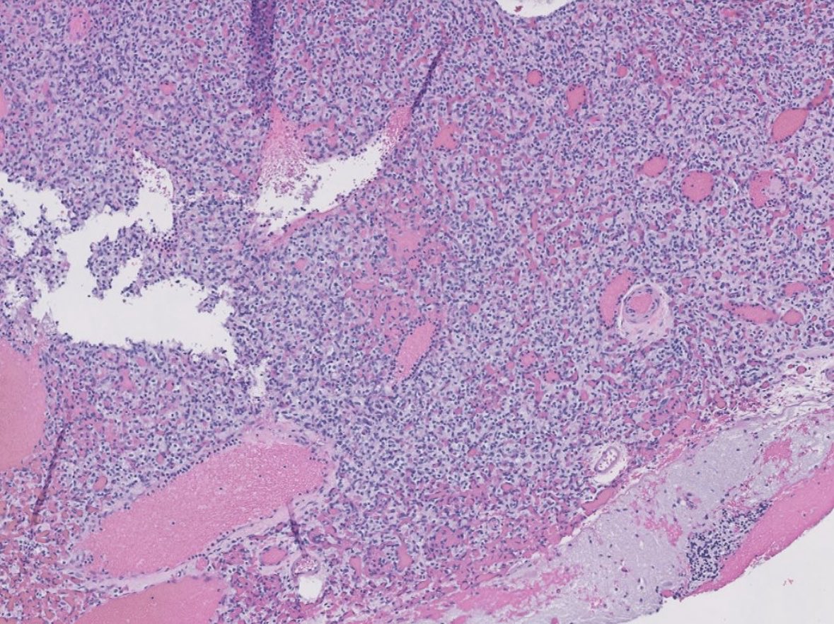 PeterKobalka's tweet image. Hemangioblastoma, Inhibin+. Young pt, must work up for VHL! (Trainees; this is the MOST POPULAR tumor syndrome for testing) #cnspath #neuropath #neuropathology #pathx #pathtwitter