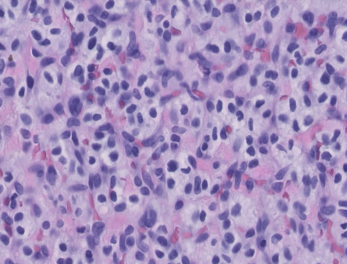 PeterKobalka's tweet image. Hemangioblastoma, Inhibin+. Young pt, must work up for VHL! (Trainees; this is the MOST POPULAR tumor syndrome for testing) #cnspath #neuropath #neuropathology #pathx #pathtwitter
