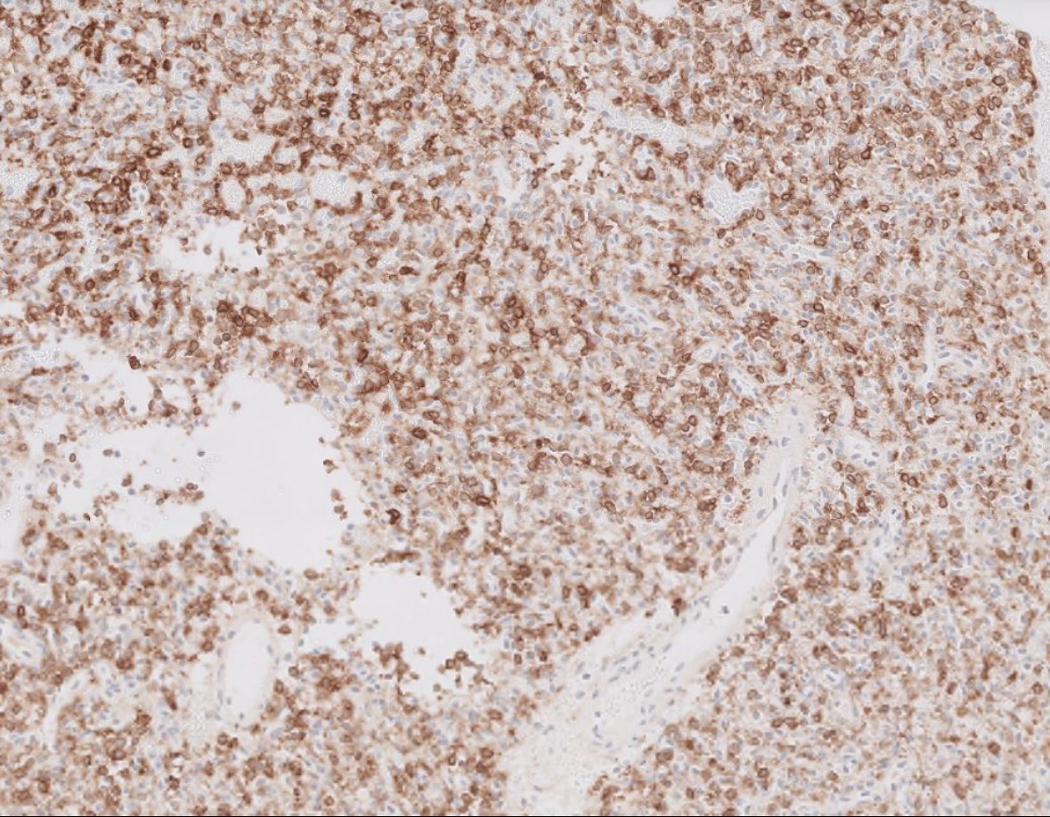 PeterKobalka's tweet image. Hemangioblastoma, Inhibin+. Young pt, must work up for VHL! (Trainees; this is the MOST POPULAR tumor syndrome for testing) #cnspath #neuropath #neuropathology #pathx #pathtwitter