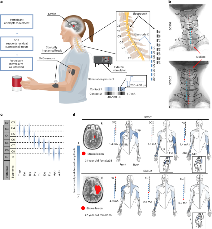 Danny Huang, MD (@yuhaohuangmd) on Twitter photo Electrical stimulation of the spinal cord can reignite movement years after stroke. Fascinating <a href="/NatureMedicine/">Nature Medicine</a> study showed epidural stimulation of cervical dorsal roots enabled two individuals to regain functional arm and hand control within days. Electrical stimulation of the spinal cord can reignite movement years after stroke. Fascinating <a href="/NatureMedicine/">Nature Medicine</a> study showed epidural stimulation of cervical dorsal roots enabled two individuals to regain functional arm and hand control within days.