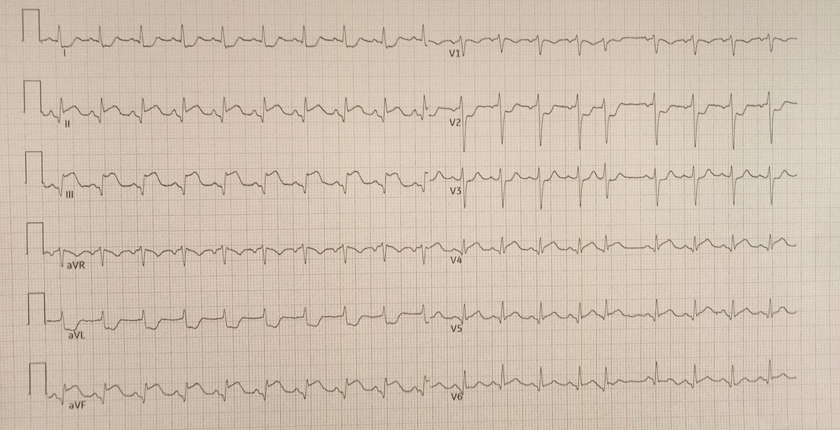 49-year-old woman with Rendu Osler syndrome, came into ER yesterday for suspected renal colic, complained of lumbar pain, arthralgia, reported fever ( left ECG ). Discharged. Returns today with oppressive epigastralgia, general malaise ( right ECG)