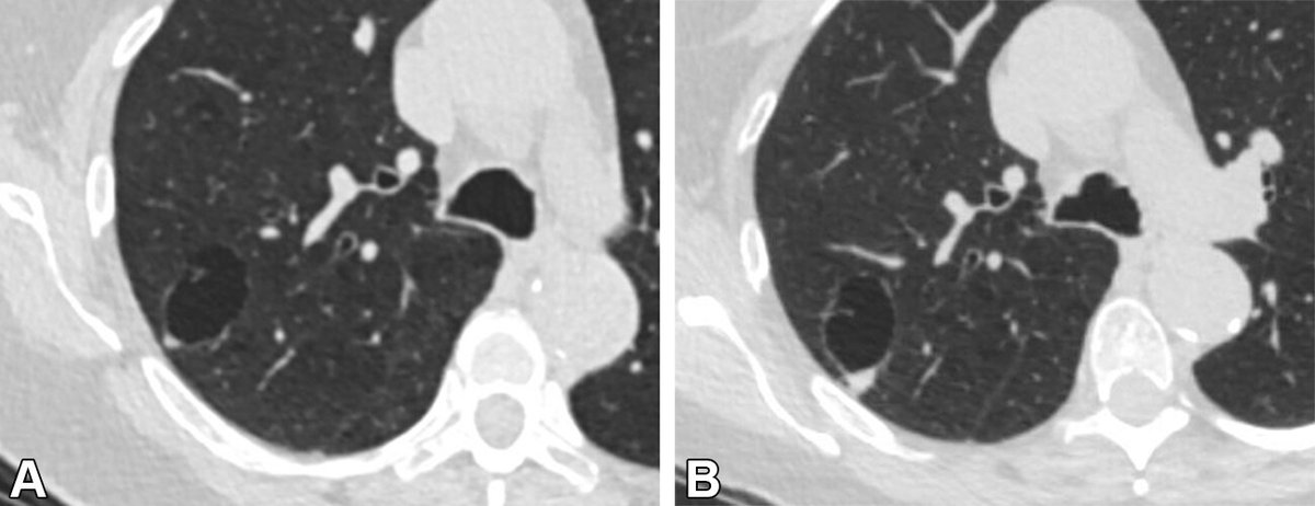 Radiology (@radiology_rsna) on Twitter photo Cystic lung lesions with nodular wall thickening have an increased risk of malignancy, although most exhibit indolent behavior, with slow growth and early stage at the time of diagnosis. <a href="/scbyrne2/">Suzanne Byrne</a> bit.ly/3SLftVr Cystic lung lesions with nodular wall thickening have an increased risk of malignancy, although most exhibit indolent behavior, with slow growth and early stage at the time of diagnosis. <a href="/scbyrne2/">Suzanne Byrne</a> bit.ly/3SLftVr