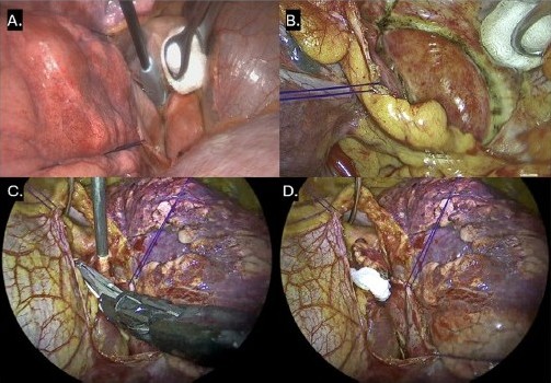 Journal of Neuroimaging (@jneuroimaging) on Twitter photo Transcranial Doppler Monitoring of the Wolf Procedure Versus Conventional Ablation to Treat Atrial Fibrillation
onlinelibrary.wiley.com/doi/10.1111/jo…
#neuroimaging #neurology #neurotwitter #neurorad #radres <a href="/WileyNeuro/">Wiley Neuro</a> <a href="/asneuroimaging/">American Society of Neuroimaging</a> #tcd #atrialfibrillation #wolfprocedure #minimaze Transcranial Doppler Monitoring of the Wolf Procedure Versus Conventional Ablation to Treat Atrial Fibrillation
onlinelibrary.wiley.com/doi/10.1111/jo…
#neuroimaging #neurology #neurotwitter #neurorad #radres <a href="/WileyNeuro/">Wiley Neuro</a> <a href="/asneuroimaging/">American Society of Neuroimaging</a> #tcd #atrialfibrillation #wolfprocedure #minimaze