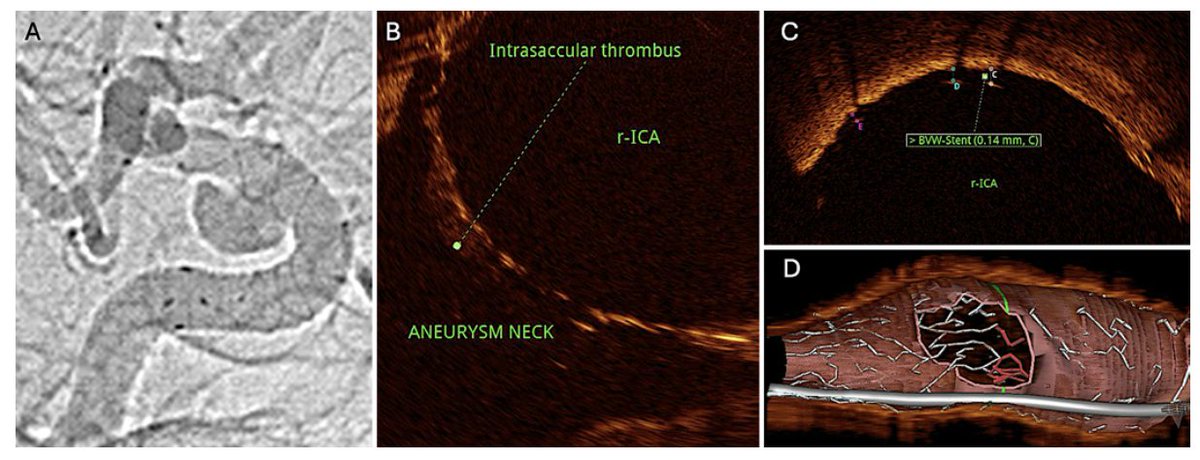 #OnlineFirst: Early experience using optical coherence tomography for intraluminal evaluation of vascular healing associated with endovascular treatment of intracranial aneurysms. 

thejns.org/view/journals/….