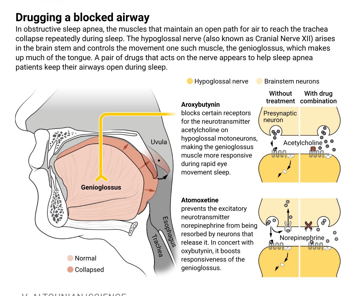 Uyku apnesi olanlar için önemli gelişme:

Geceleri maskeyle uyumak zorunda kalan milyonlarca kişi için artık bir hapla tedavi mümkün olabilir.

Yeni geliştirilen bir ilaç ile yapılan  (AD109) ve 6 ay süren bir çalışmada, ilacı kullananların nefes durmaları % 56 oranında azaldı.