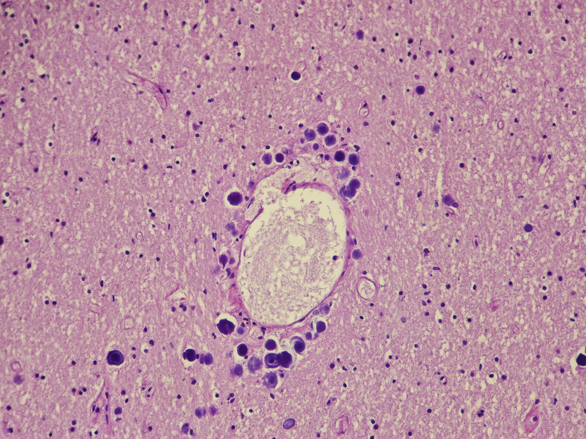 #neuropath corpora amylacea - basophilic, lamellated polyglucosan structures.
Accumulate in astrocytic processes with advancing age.
Typically subpial (pics 1-2) &amp; perivascular (pics 3-4).
🚨May mimic fungal colonies, especially as they are also PAS+, GMS+

#PathTwitter